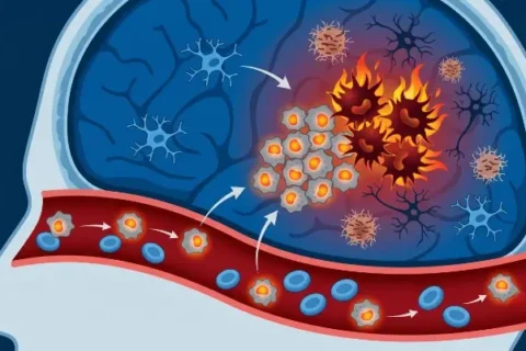 New research found that brain immune cells in Alzheimer’s patients can carry cancer-driving mutations detectable in a routine blood test, and drugs that target those mutations already exist